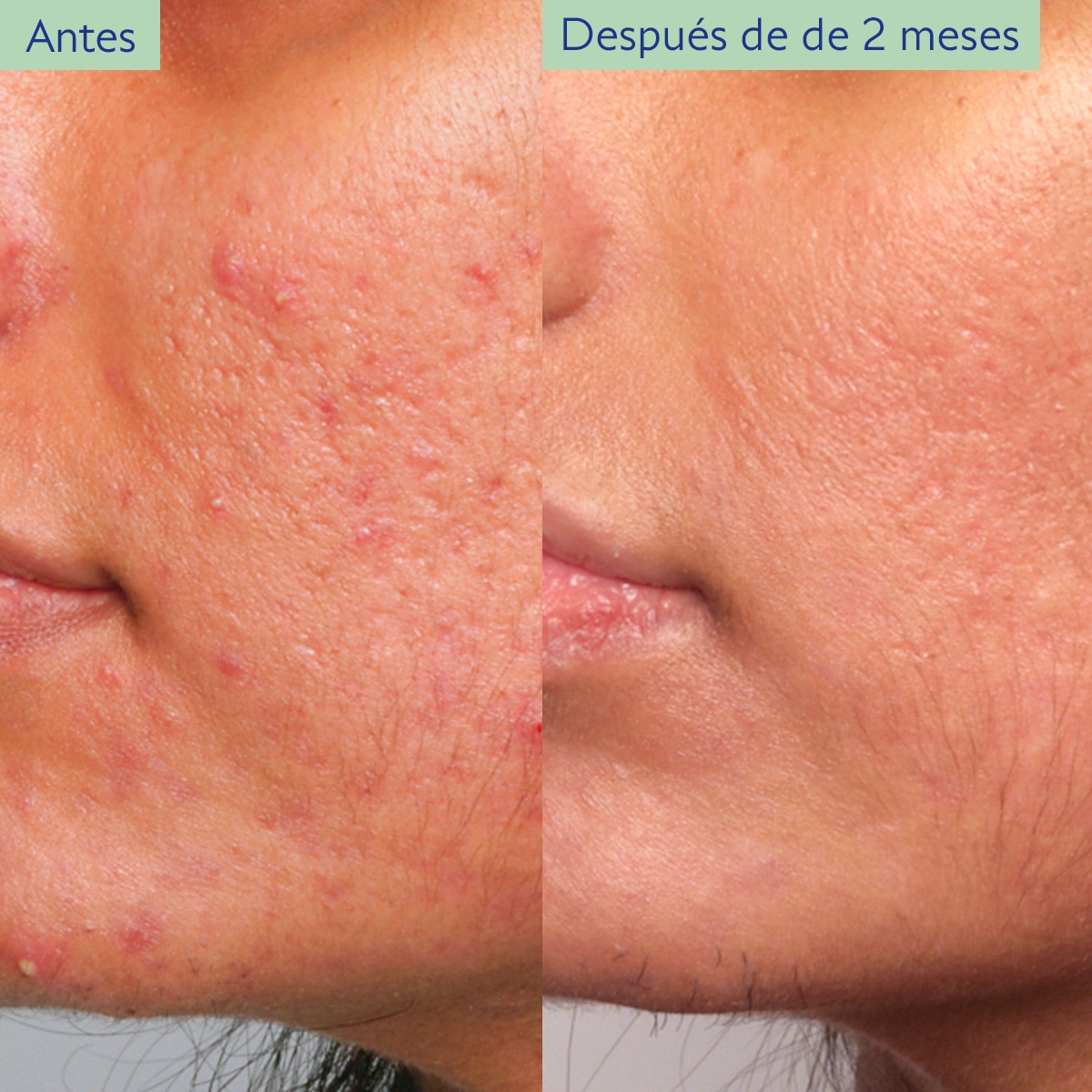 ESENCIALES PARA PIEL CON TENDENCIA ACNEICA (SET PARA CUIDADO DE LA PIEL)